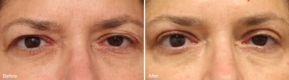 Upper Eyelid Surgery Before and After Photos in Philadelphia, PA, Patient 1031