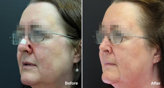 Reconstructive Surgery Before and After Photos in Philadelphia, PA, Patient 1214