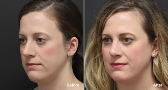 Rhinoplasty Before and After Photos in Philadelphia, PA, Patient 820