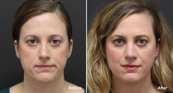 Rhinoplasty Before and After Photos in Philadelphia, PA, Patient 820