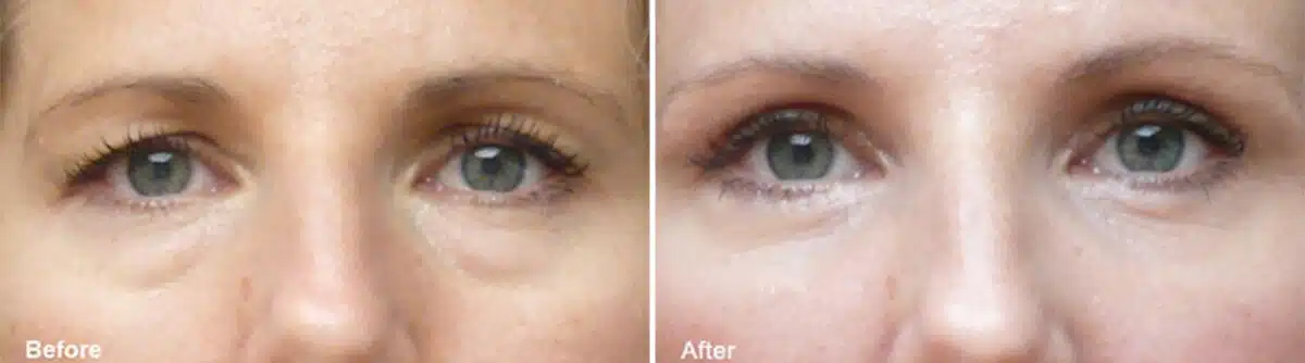 Patient 923, Upper and Lower Eyelid Surgery Before and After Photos Upper and Lower Eyelid Surgery Before and After Photos in Philadelphia, PA, Patient 923