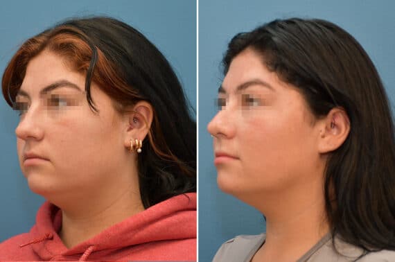 Rhinoplasty Before and After Photos in Voorhees Township, NJ, Patient 8185