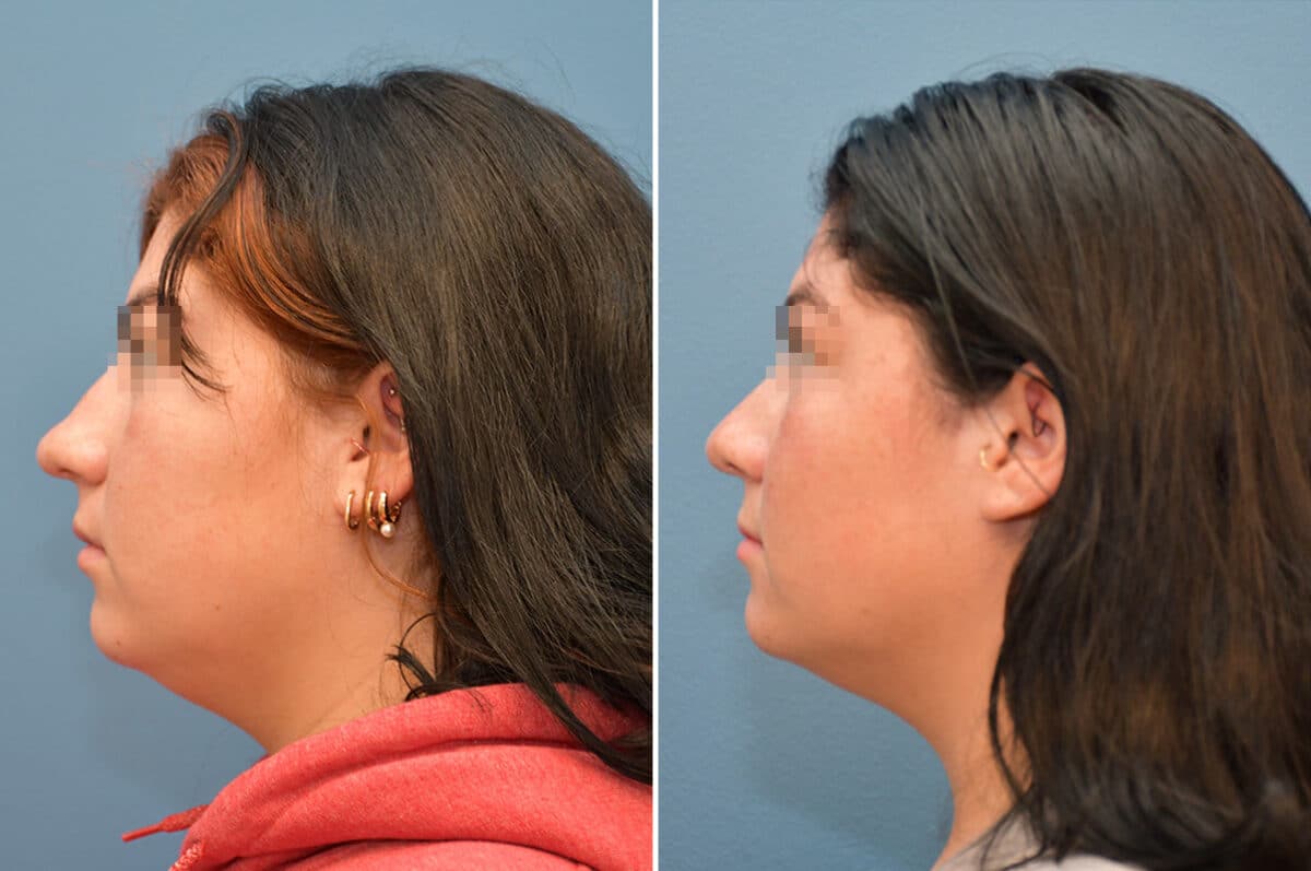 Patient 8185, Rhinoplasty Before and After Photos Rhinoplasty Before and After Photos in Voorhees Township, NJ, Patient 8185