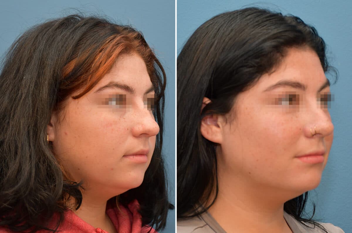 Patient 8185, Rhinoplasty Before and After Photos Rhinoplasty Before and After Photos in Voorhees Township, NJ, Patient 8185