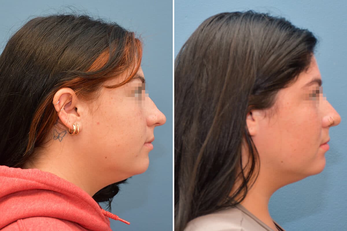 Patient 8185, Rhinoplasty Before and After Photos Rhinoplasty Before and After Photos in Voorhees Township, NJ, Patient 8185