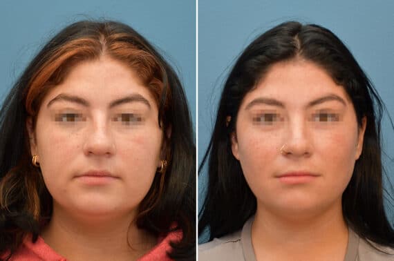 Rhinoplasty Before and After Photos in Voorhees Township, NJ, Patient 8185