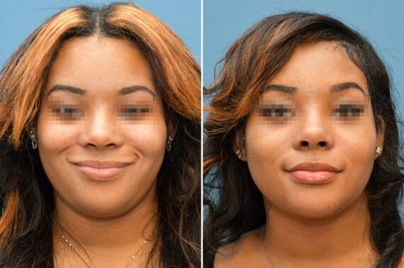 Rhinoplasty Before and After Photos in Voorhees Township, NJ, Patient 8225