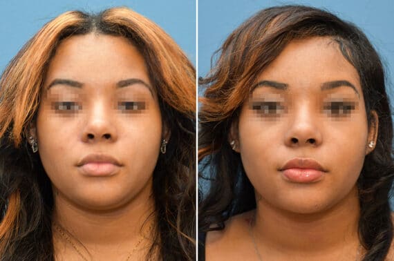 Rhinoplasty Before and After Photos in Voorhees Township, NJ, Patient 8225