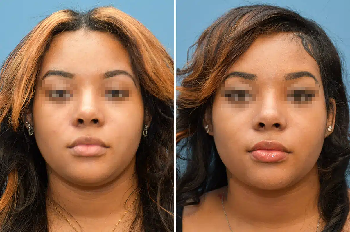 Rhinoplasty before & after photo patient