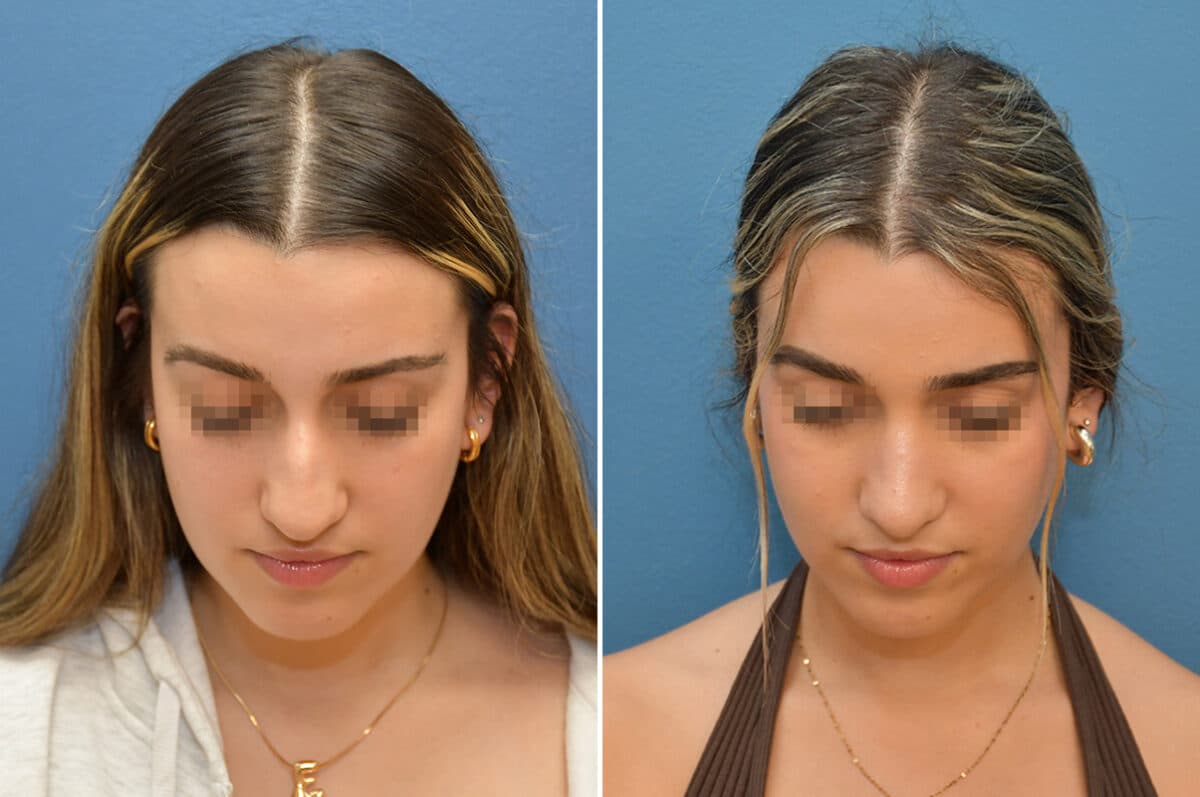 Patient 8228, Rhinoplasty Before and After Photos Rhinoplasty Before and After Photos in Voorhees Township, NJ, Patient 8228