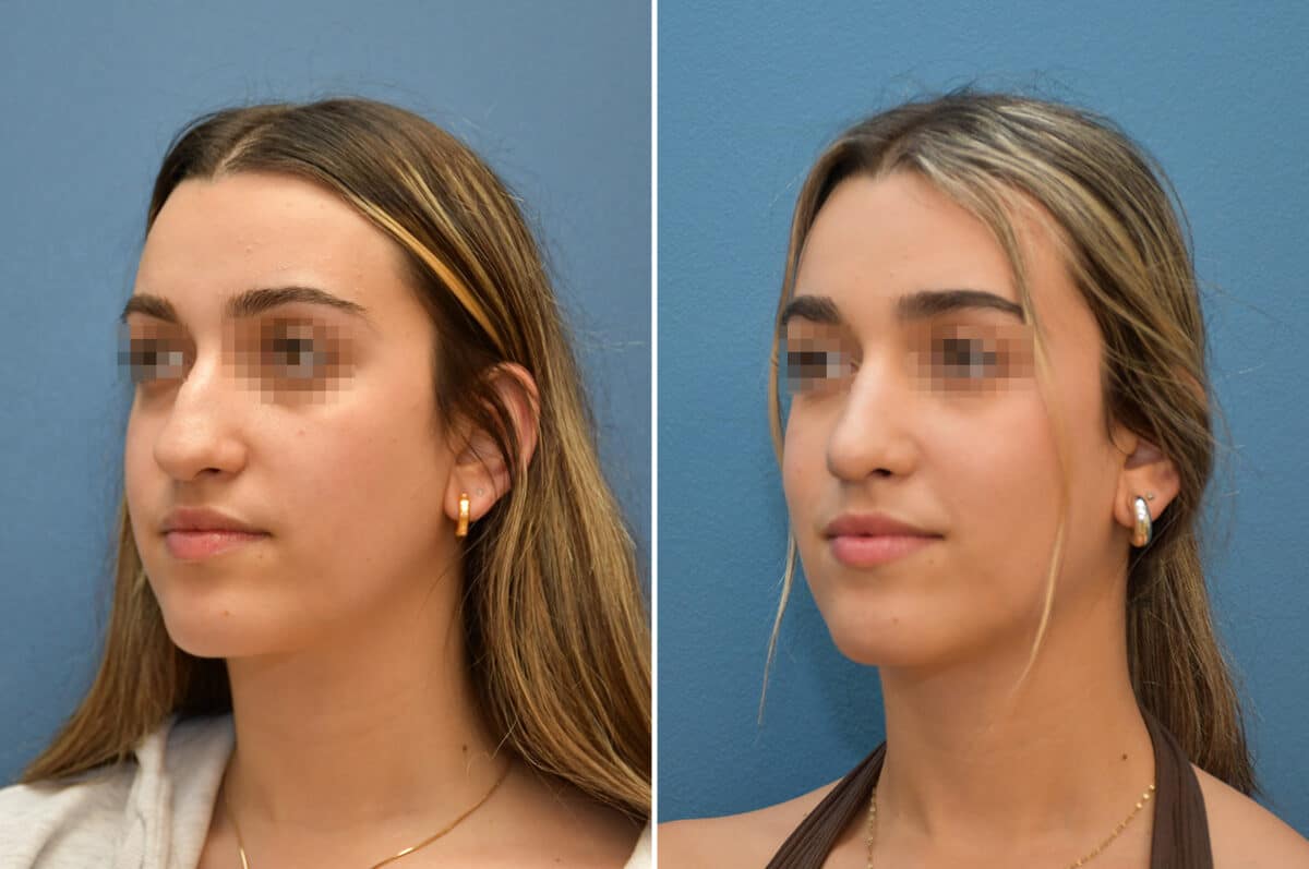 Patient 8228, Rhinoplasty Before and After Photos Rhinoplasty Before and After Photos in Voorhees Township, NJ, Patient 8228