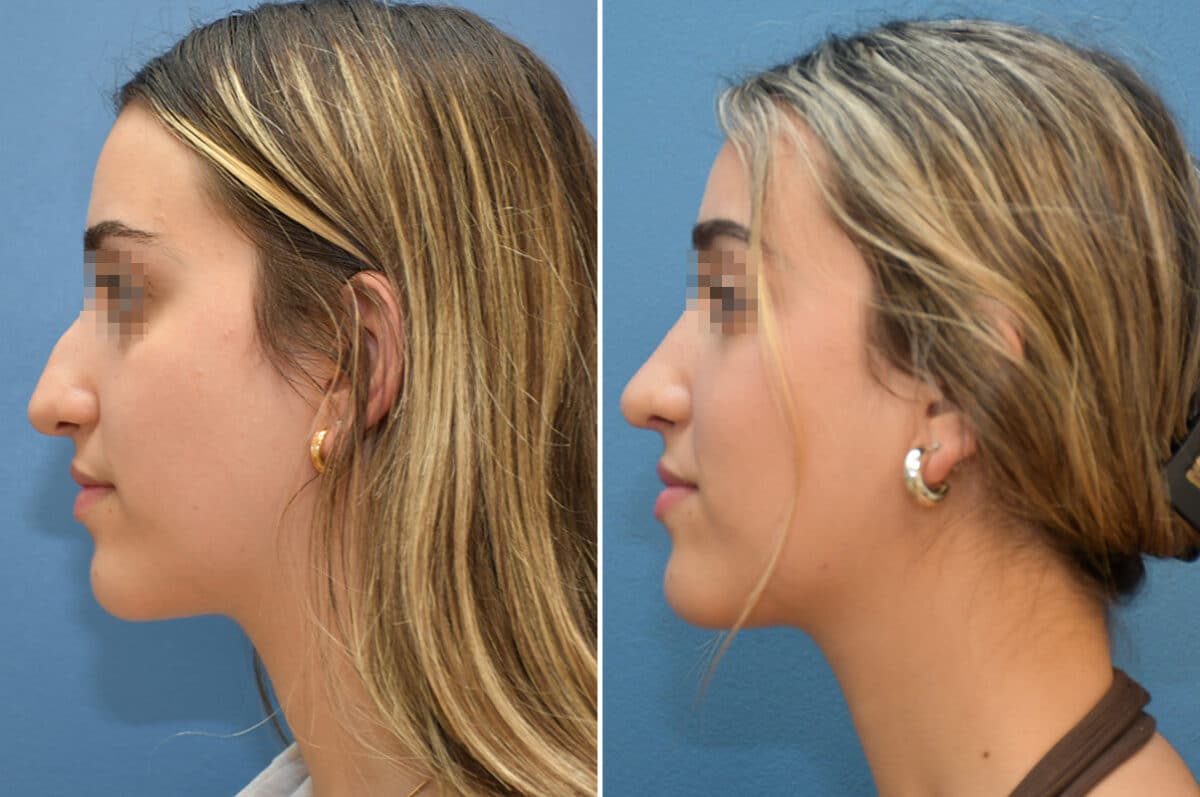 Patient 8228, Rhinoplasty Before and After Photos Rhinoplasty Before and After Photos in Voorhees Township, NJ, Patient 8228
