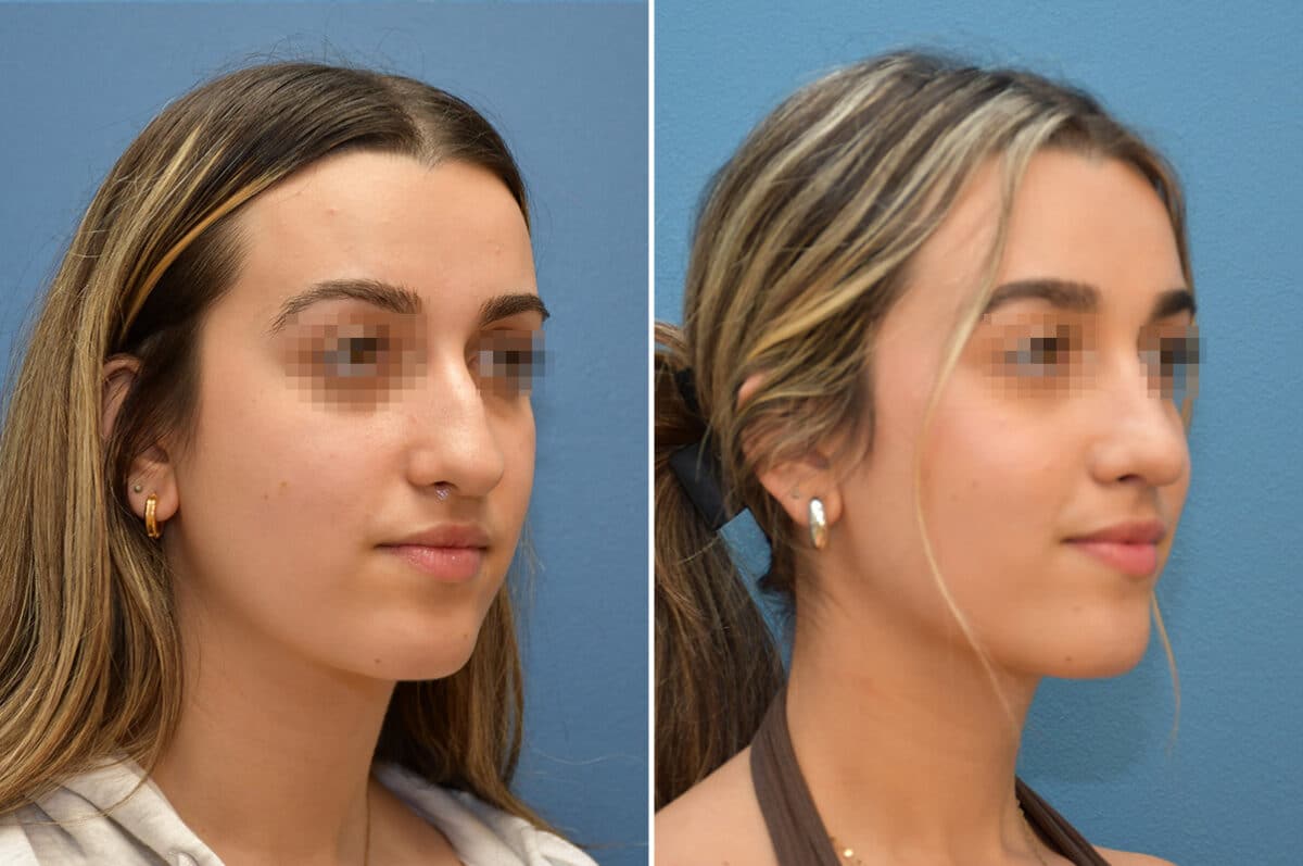 Patient 8228, Rhinoplasty Before and After Photos Rhinoplasty Before and After Photos in Voorhees Township, NJ, Patient 8228