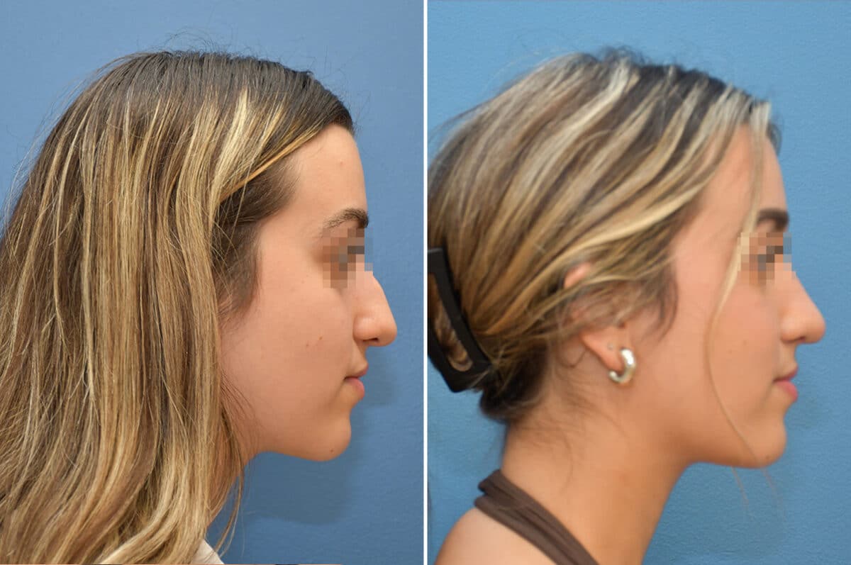 Patient 8228, Rhinoplasty Before and After Photos Rhinoplasty Before and After Photos in Voorhees Township, NJ, Patient 8228