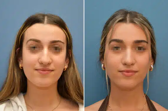 Rhinoplasty Before and After Photos in Voorhees Township, NJ, Patient 8228