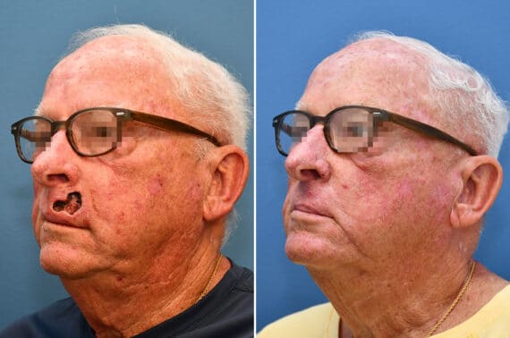 Mohs Reconstruction Before and After Photos in Voorhees Township, NJ, Patient 8236