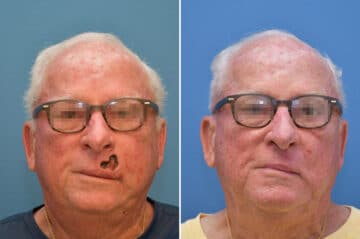 Mohs Reconstruction Before and After Photos in Voorhees Township, NJ, Patient 8236