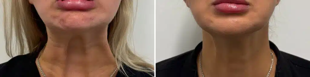 Botox for the neck, before and after pictures of a female patient.