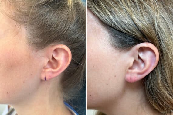 Earlobe Repair Before and After Photos in Princeton, NJ, Patient 8341