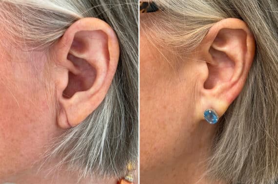 Earlobe Repair Before and After Photos in Princeton, NJ, Patient 8359