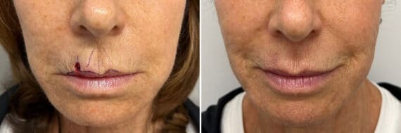 Mohs Reconstruction Before and After Photos in Princeton, NJ, Patient 8361