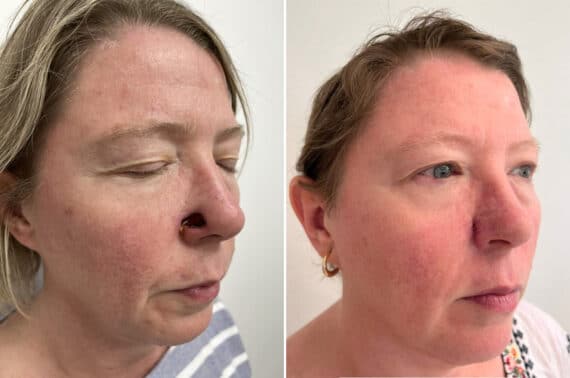 Mohs Reconstruction Before and After Photos in Princeton, NJ, Patient 8363