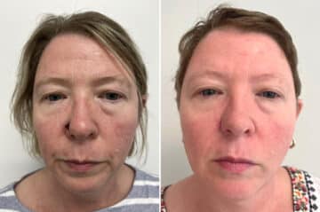 Mohs Reconstruction Before and After Photos in Princeton, NJ, Patient 8363