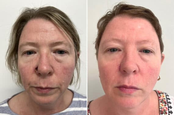 Mohs Reconstruction Before and After Photos in Princeton, NJ, Patient 8363