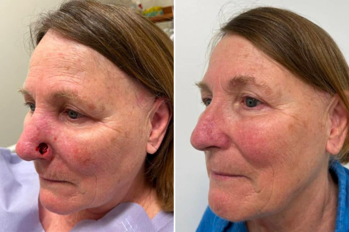 Mohs Reconstruction Before and After Photos in Princeton, NJ, Patient 8366