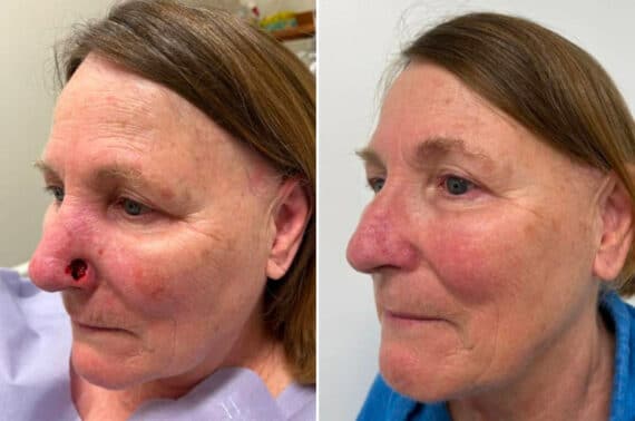 Mohs Reconstruction Before and After Photos in Princeton, NJ, Patient 8366