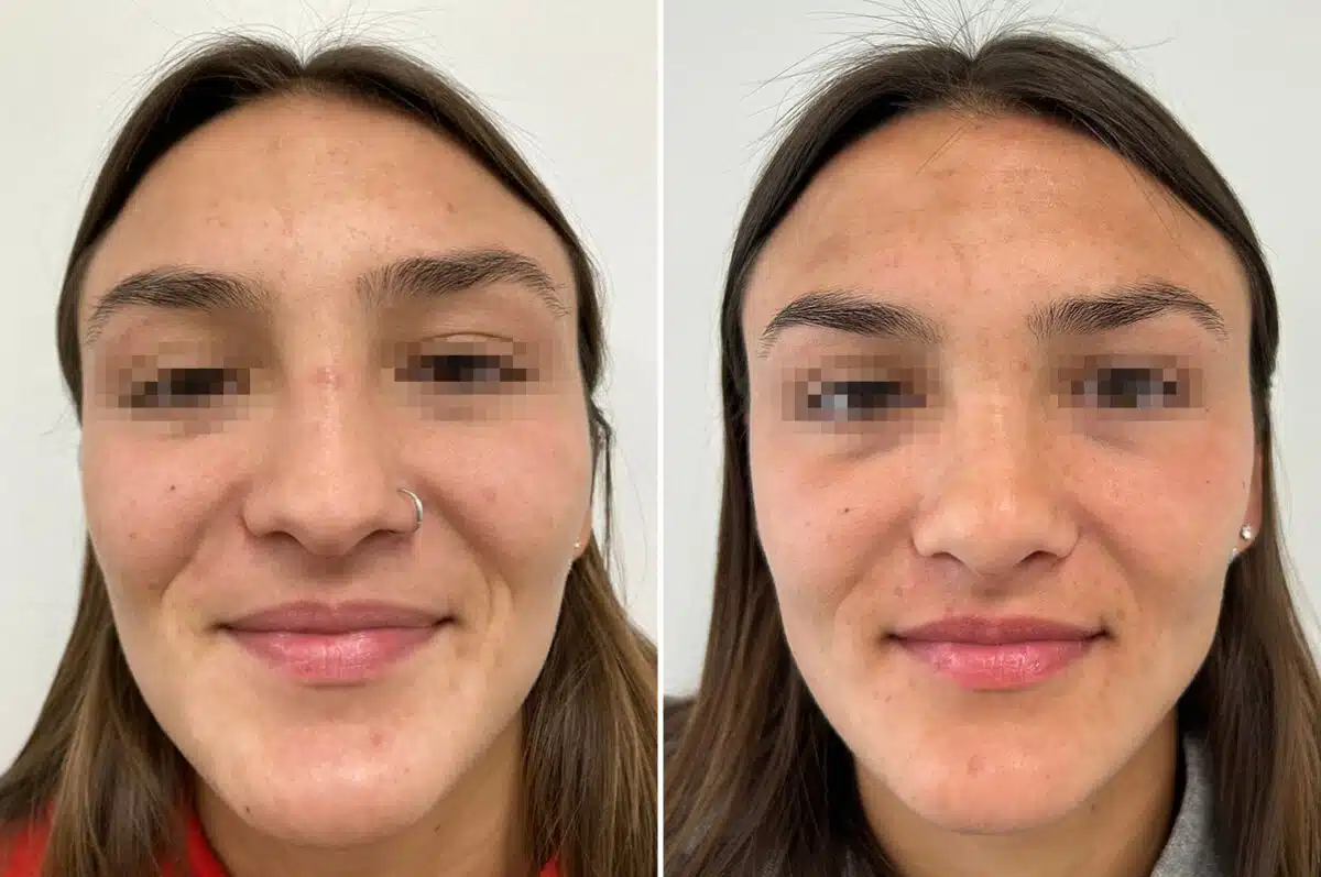 Revision Rhinoplasty Before and After Photos in Princeton, NJ, Patient 8368
