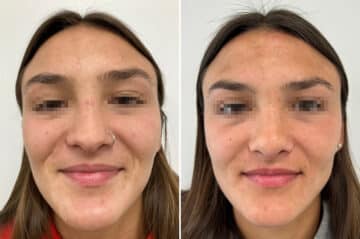 Revision Rhinoplasty Before and After Photos in Princeton, NJ, Patient 8368
