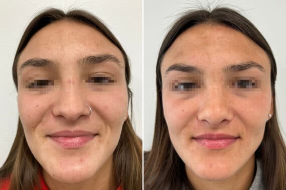 Revision Rhinoplasty Before and After Photos in Princeton, NJ, Patient 8368