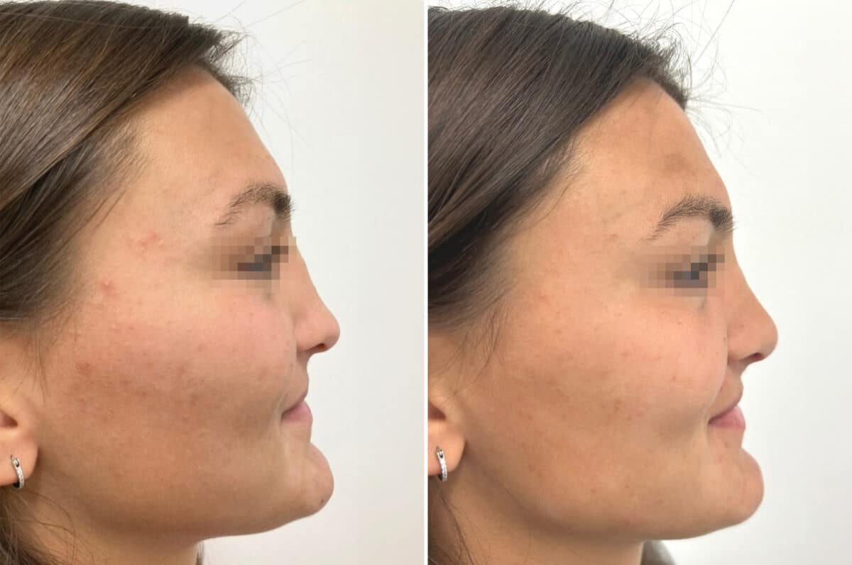 Revision Rhinoplasty Before and After Photos in Princeton, NJ, Patient 8368
