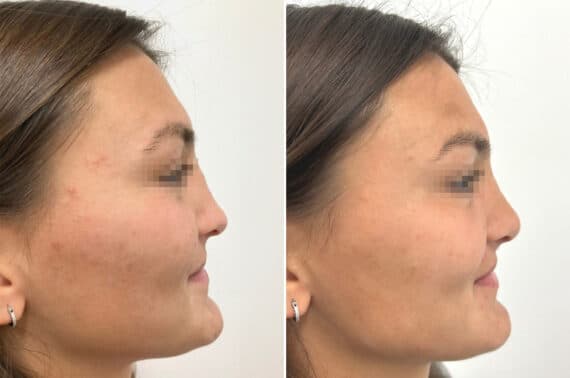 Revision Rhinoplasty Before and After Photos in Princeton, NJ, Patient 8368
