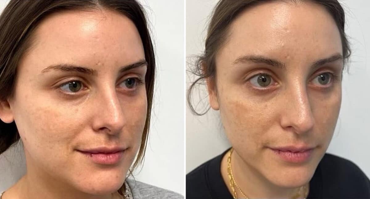 IPL Before and After Photos in Philadelphia, PA, Patient 2888