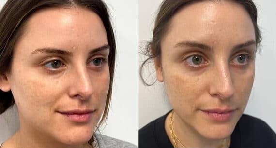 IPL Before and After Photos in Philadelphia, PA, Patient 2888