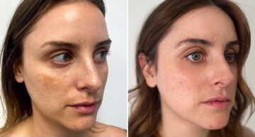 IPL Before and After Photos in Philadelphia, PA, Patient 2888
