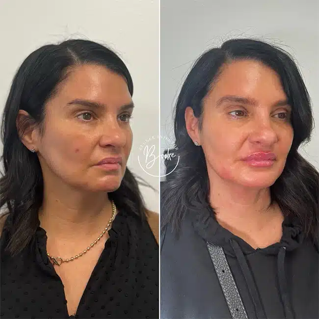 Before & After Photos Brooke Carrero, RN