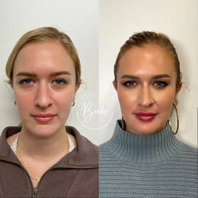 Before & After Photos Brooke Carrero, RN