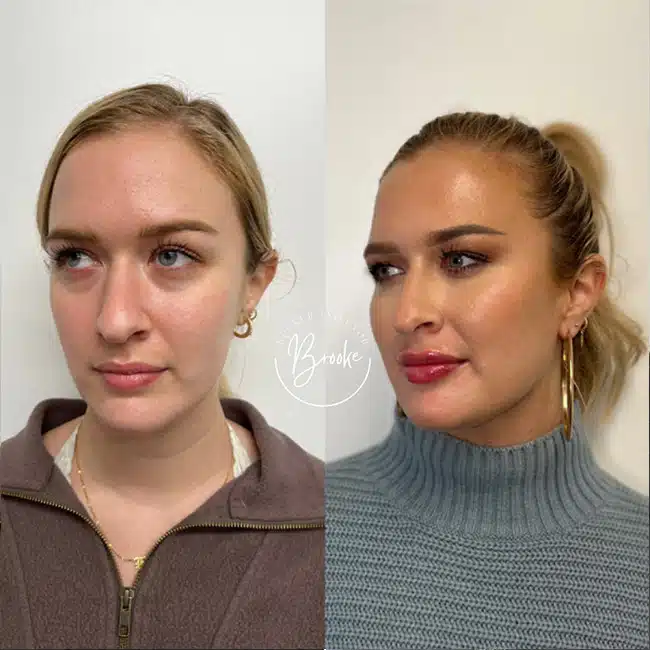 Before & After Photos Brooke Carrero, RN