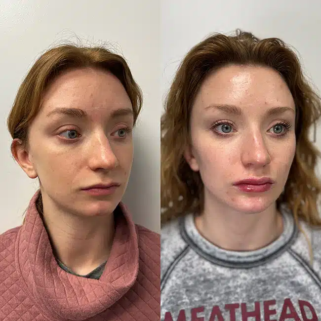 Before & After Photos Brooke Carrero, RN