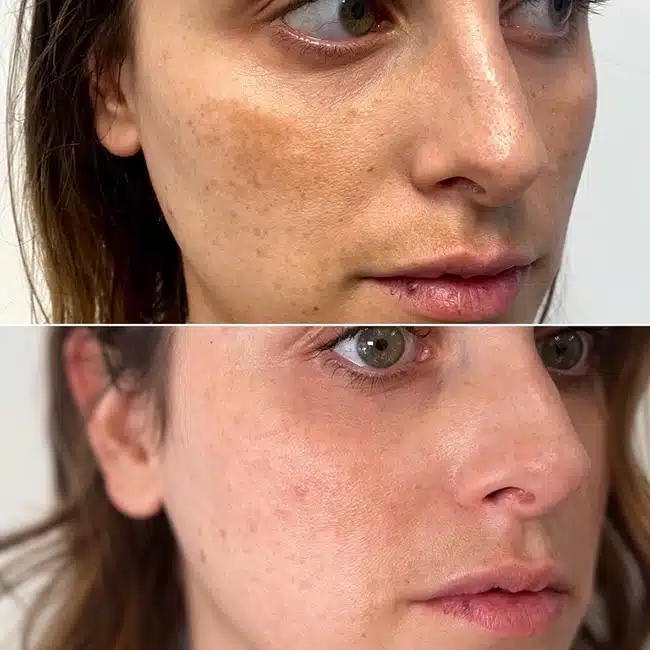 Before & After Photos Brooke Carrero, RN