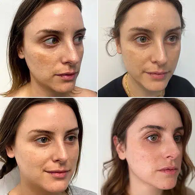 Before & After Photos Brooke Carrero, RN