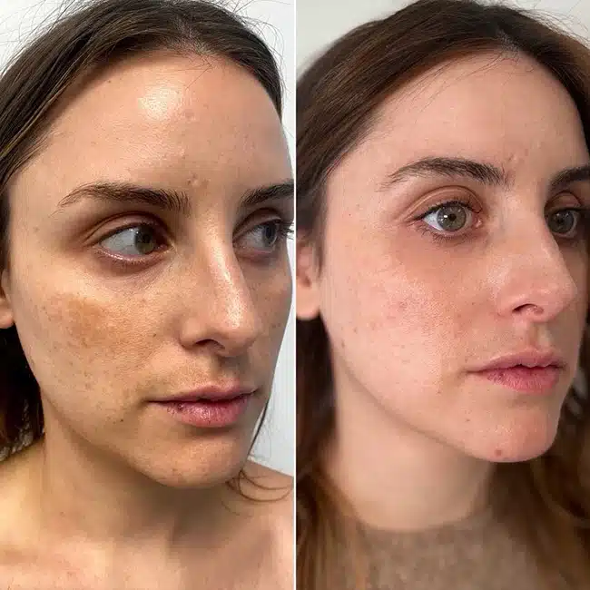 Before & After Photos Brooke Carrero, RN