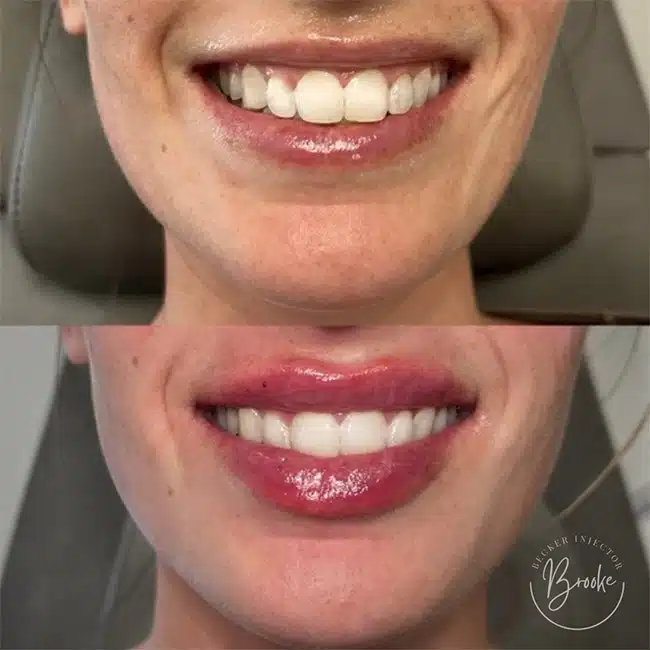 Before & After Photos Brooke Carrero, RN