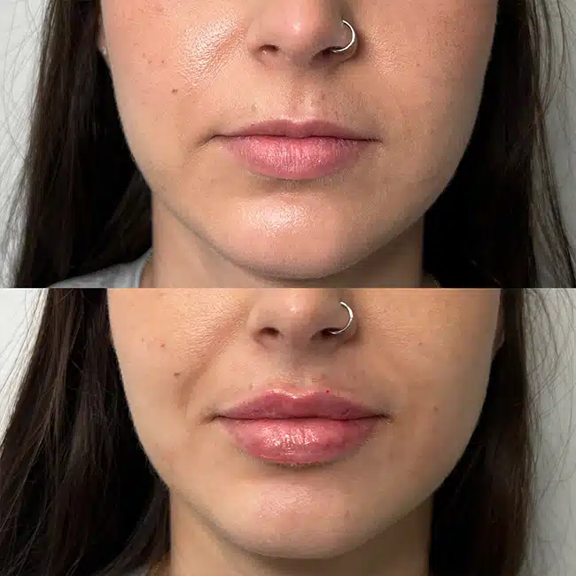 Before & After Photos Brooke Carrero, RN