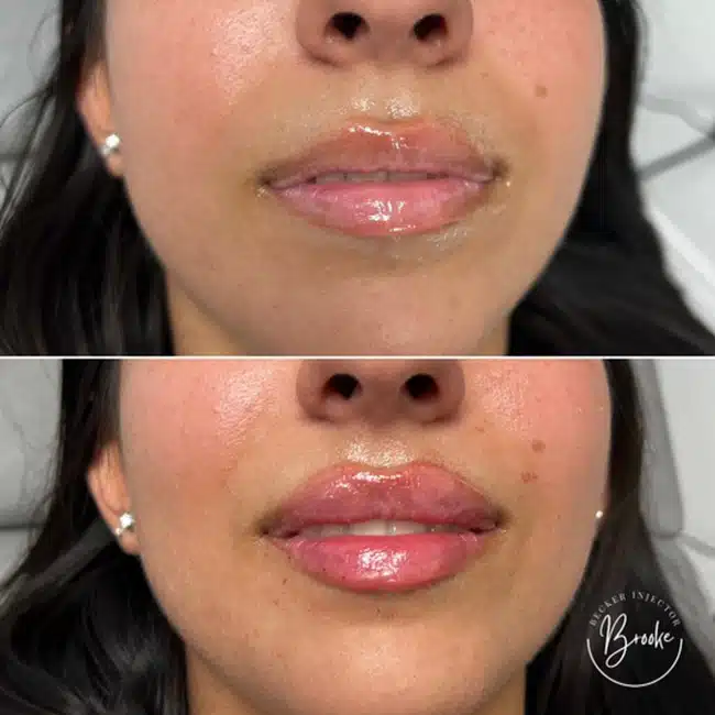 Before & After Photos Brooke Carrero, RN