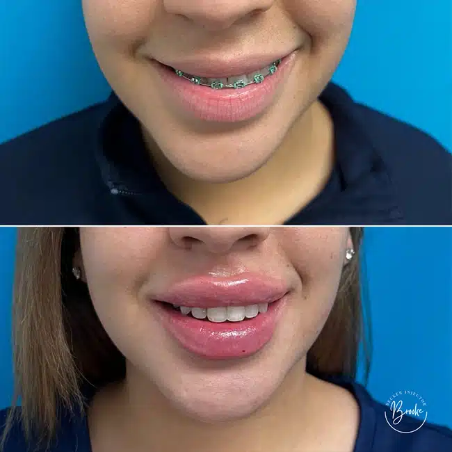 Before & After Photos Brooke Carrero, RN