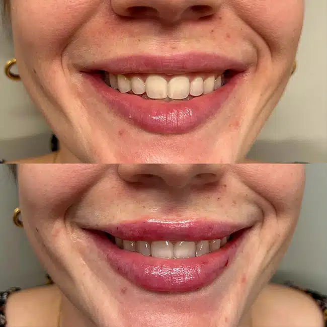 Before & After Photos Brooke Carrero, RN